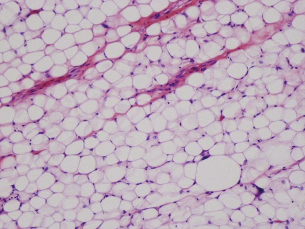3 200 µm 100 µm 200 µm (d) (c) 100 µm (e) (f) Figure 3: (c) show the high-power-magnification microscopic specimen of the small tumor, and (d) (f) show those of the giant tumor.