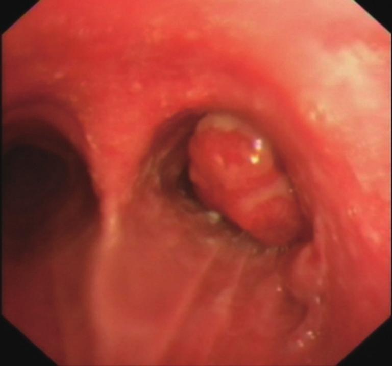 the level of carina with no obvious mediastinal lymphadenopathy; (B) flexible bronchoscopy revealed a smooth