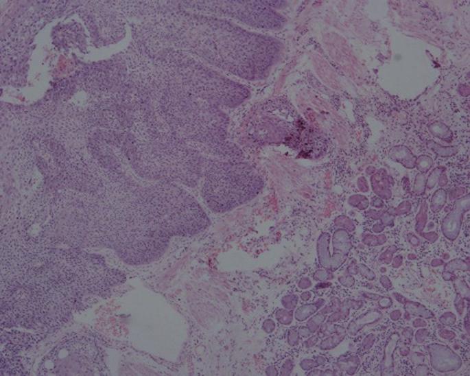 E394 Yang et al. Uniportal VATS right sleeve pneumonectomy A B C Figure 3 Histologic slide of tumor: squamous carcinoma in situ of the bronchus intermedius.