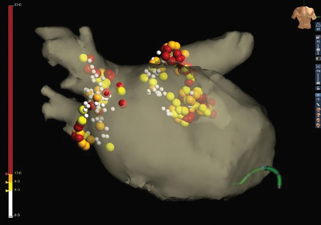 Ablation lesions were marked in different colors depending on FTI as follows: white (<50 g); yellow (50-150 g); orange (50-300 g); red (>300 g). Figure 5. PVI. Same patient as in Figure 4.