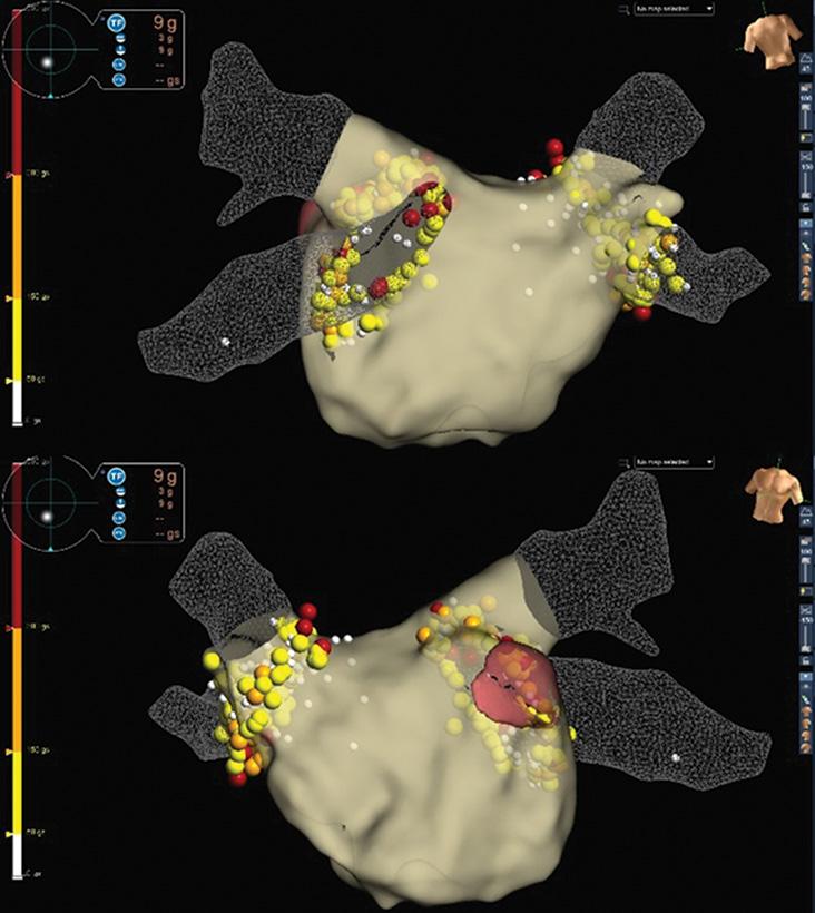 However, RF power is relatively constant during ablation. Therefore, we included RF application duration in the predefined model of ablation lesions (Fig 1).
