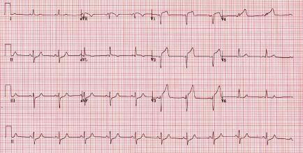 Figure 1. George s 12-lead ECG. FP, rapid diagnosis and risk assessment will ensure initiation of treatment and best practice guidelines are met. Q & A What is Vital Heart Response?