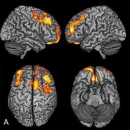 PD cognitive symptoms Executive dysfunction: anterior cingulate cortex