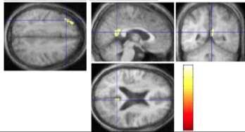 dysfunction: Dorso-lateral prefrontal cortex PCC Caudate nucleus