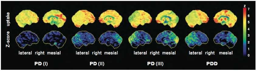 From PD to PDD Hypometabolic cortical areas frequently observed in nondemented PD correspond to those in PDD and DLB FDG-PET findings in patients with PD without dementia span