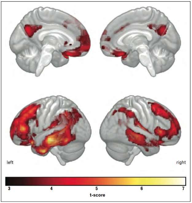 DLB metabolic correlations Correlation between MMSE and regional FDG uptake in DLB lateral frontal, temporal and parietal association cortices cingulate gyrus and precuneus caudate nucleus no
