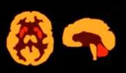 MSA FDG-PET pattern NL MSA consistent with MSA neuropathological features Degenerative changes in: Striata (putamen < caudate) Cerebellum Brainstem More advenced stages: Frontal lobes Parietal lobes