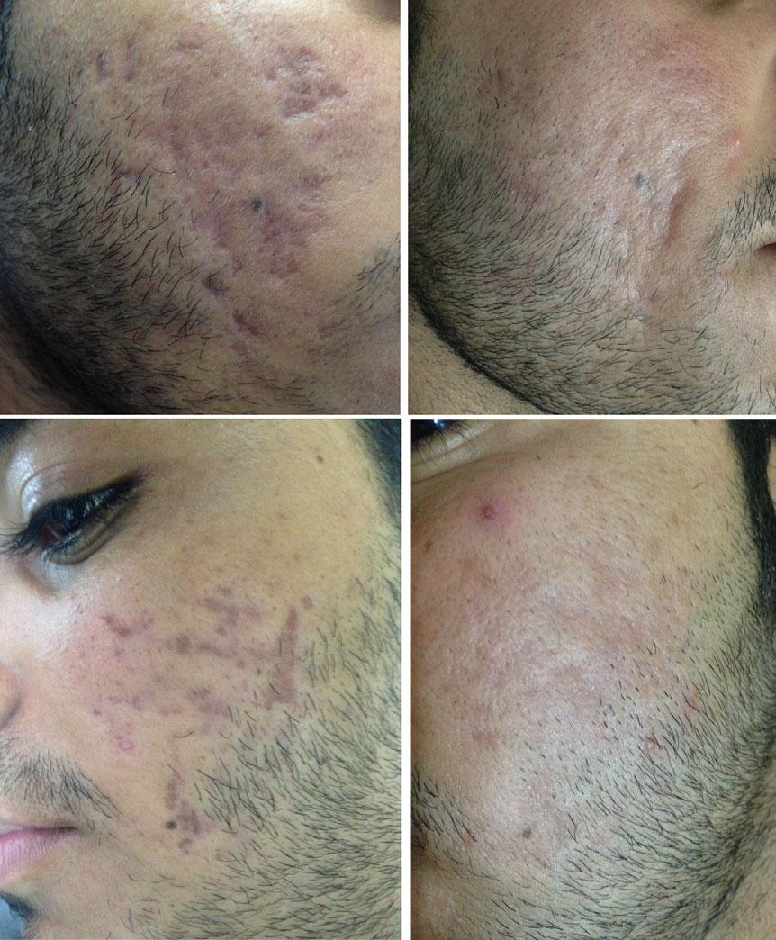 Figure 8 Acne scar of a 25-years-old male with pretreatment and post-treatment right and left half of face showing significant improvement (margin of each scar can still be appreciated in left half).