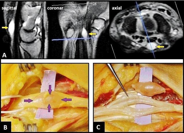 Schmidt I 290 CASE LETTERS REPORT TO THE EDITOR PEER REVIEWED OPEN ACCESS Schwannoma of the median nerve To the editors, A 57-year-old female presented with a two-year history of increasing painful