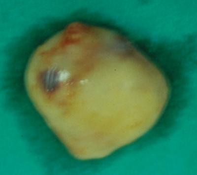 The tumor was excised by transmandibular transpterigoid approach (inferior approach) under general anesthesia.