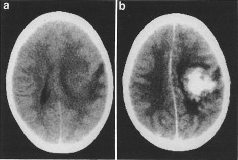 S. K. Ofori-Kwakye, et al. FIG. 1. Computerized tomography scans, plain (a) and contrast-enhanced (b), obtained on presentation to the Children's Hospital, Boston.