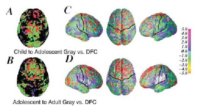 Correlation between brain growth and reduced