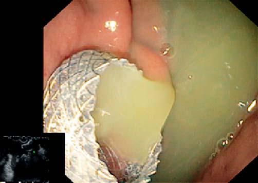 Fig. 3 Endoscopic view of an intraluminal flange of fully covered lumen-apposing self-expandable metal stent deployed into pancreatic pseudocyst draining purulent fluid.