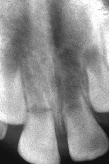 Figure 2 Periapical radiograph revealing horizontal root fracture at the level of the middle third of the maxillary right central incisor and incomplete root development of both maxillary central