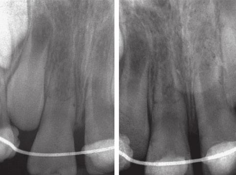 (a) (b) Figure 4 Periapical radiographs 2 (a) and 3 (b) months after splinting.