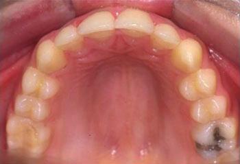 As the patient had an angle type I malocclusion with crowding and arch-length loss owing to the early loss of second primary molars and mesial drifting of first permanent molars (Fig.