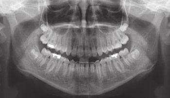 At that time, splinting periods up to 2 years were proposed for such teeth (Clark & Eleazer 2000).
