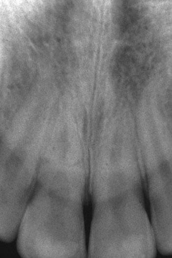 Figure 8 Periapical radiograph 10 years after the injury. Partial obliteration of the pulp space is evident in tooth 11.