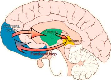 TS Pathophysiology Dysfunction of fronto-striatalthalamo-cortical circuits Leads to disinhibition of the motor and limbic system Neurotransmitters in this circuit: Glutamate