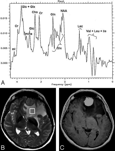 Fig 3. A meningioma in patient 12. A, Localized proton spectrum of the edema surrounding the meningioma. The NAA/Cho, Cho/, and mins/ ratios are in the normal range. NAA/ is decreased to 1.