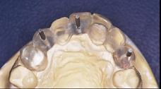 The reference point, which represents the usual thickness of a porcelain-fused-tometal restoration, aids in positioning of the abutment relative to the restoration