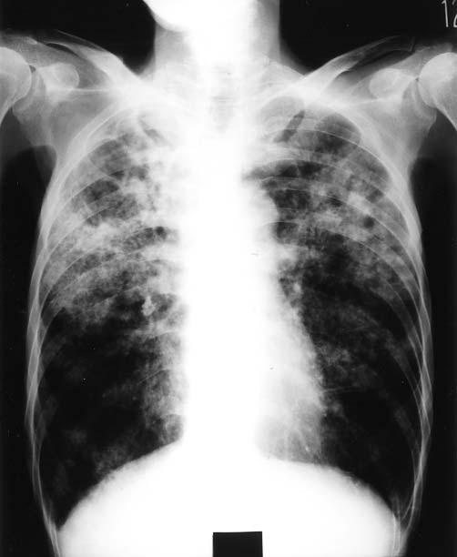Chest X-ray film showing extensive infiltrates in the