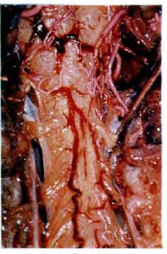 Micro-dissection spine and spinal cord vessels- 35 cadavers 3