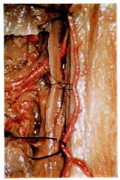 Radicular arteries reinforce the longitudinal arterial channels at various