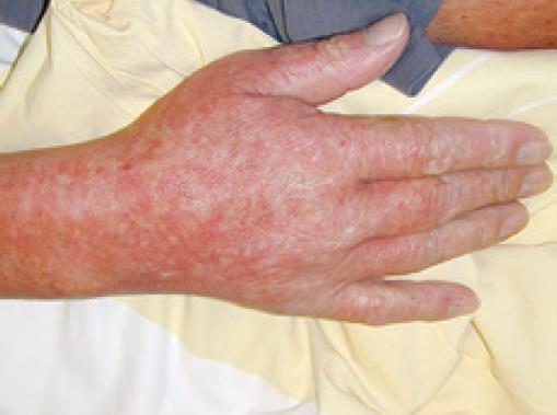 Skin GVHD Most commonly affected organ in agvhd