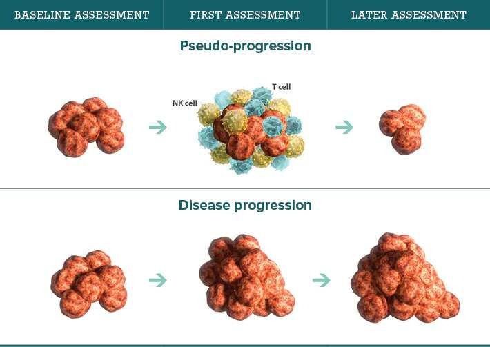 Pseudo progression In melanoma; 5% : early