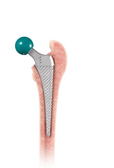 STEP 5 TRIAL REDUCTION Femoral Neck Trial Assembly Attach the appropriate neck segment to the broach. Multiple trial heads are available to help with proper restoration of hip biomechanics (22.