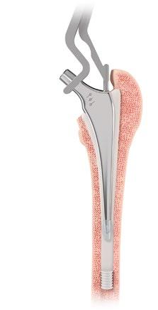 STEP 9 FEMORAL STEM IMPLANTATION -5 mm Neutral +5 mm Figure 14 Figure 15 To assemble the introducer to the stem, compress the lever and carefully locate the two forks behind the taper on the neck of
