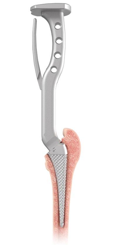 STEP 3 METAPHYSEAL PREPARATION Femoral Broaching Attach a broach two sizes smaller than the size determined during pre-operative templating to the broach handle.