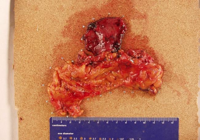indocyanine green is injected into the submucosal layer after marking around the tumor; (D) endoscopic full-thickness resection is performed after sentinel node harvest and regional lymph node
