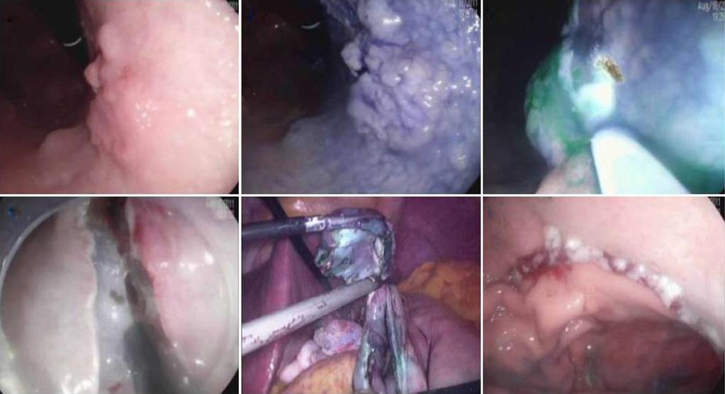 Moreover, advance in endoscopic instruments, techniques and training is essential to improve outcomes of patients with EGC. Recently, novel laser system for ESD was introduced.