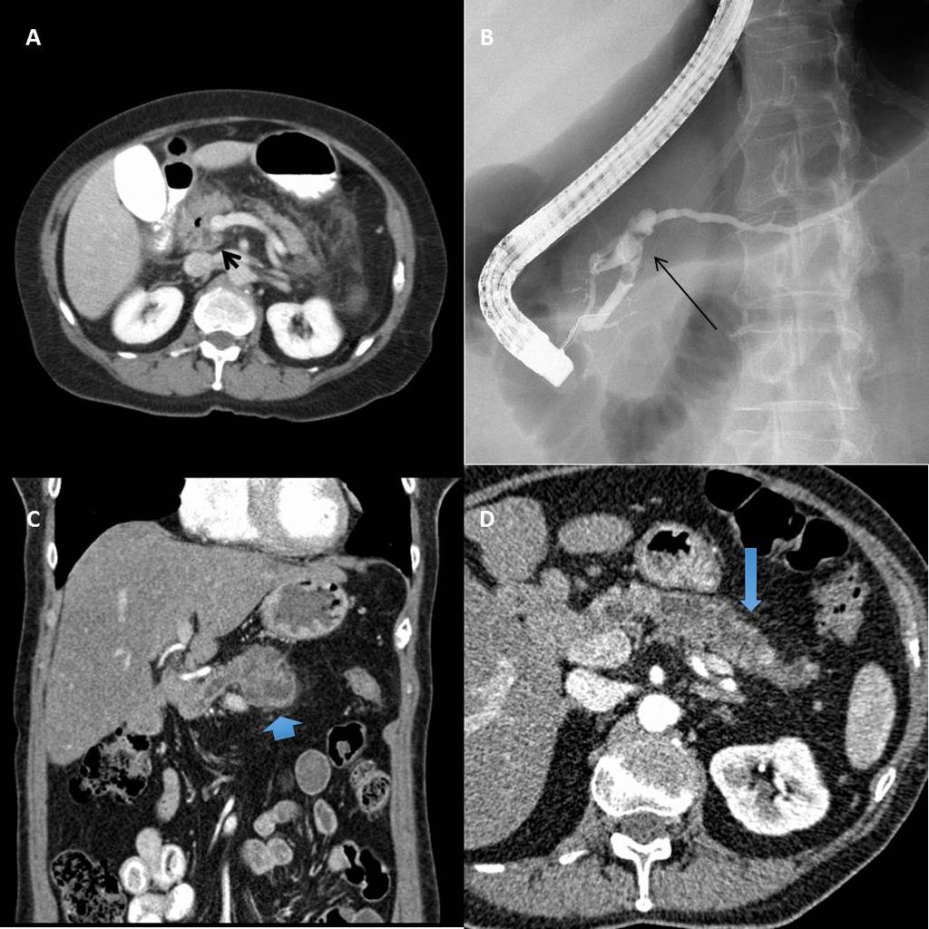 JOP. J Pancreas (Online) 2015 Sep 20; 16(5):415. Figure 1. Recurrent main-duct IPMN following partial pancreatectomy.