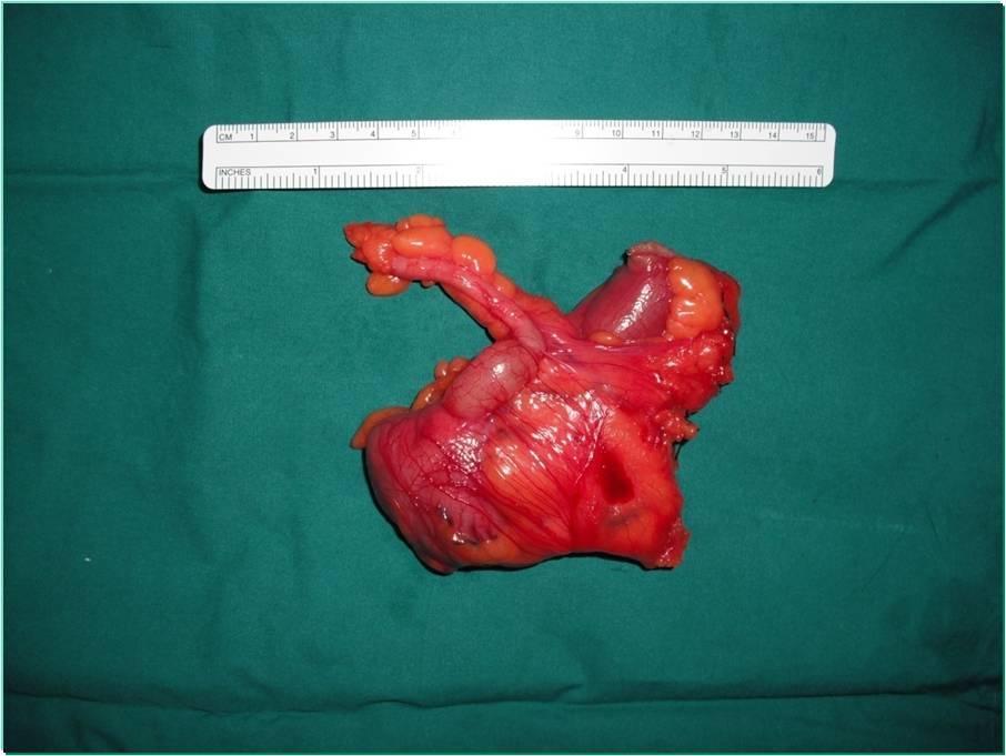 Most often at tip (70%) and if < 1.0 cm (90%) is cured by appendectomy. For tumor > 2.