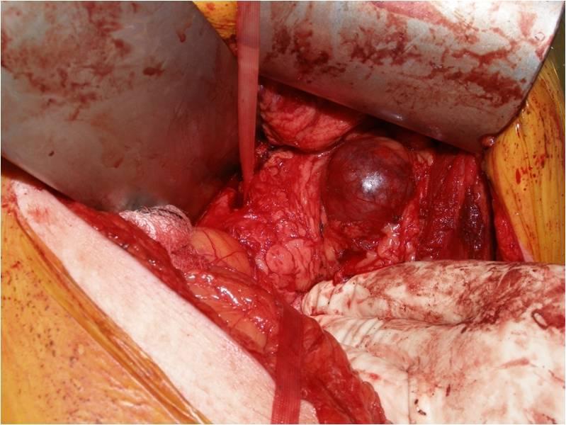 Large tumor (> 4 cm) high chance of malignancy Small pancreatic body/tail tumor should be resected by distal pancreatectomy may be resected laparoscopically Head or uncinate
