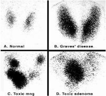 Graves disease continued, other testing The radioactive iodine uptake test measures the amount of iodine the thyroid collects from the bloodstream.