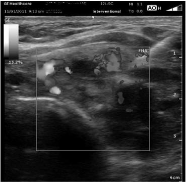 Increased vascularity biopsy 43 Non-diagnostic indicates that there are an insufficient number of thyroid cells in the aspirate and no diagnosis is possible.