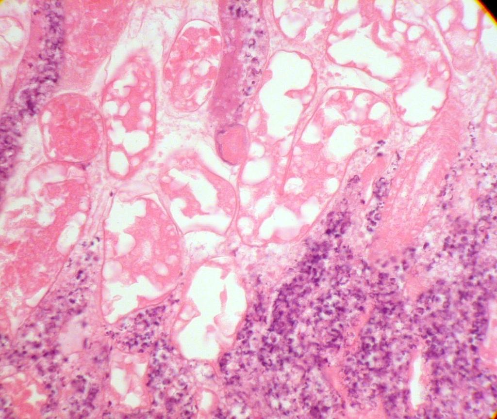 note within the affected area the basic architectural arrangement of the glomeruli and tubules is apparent however the cells resemble eosinophilic