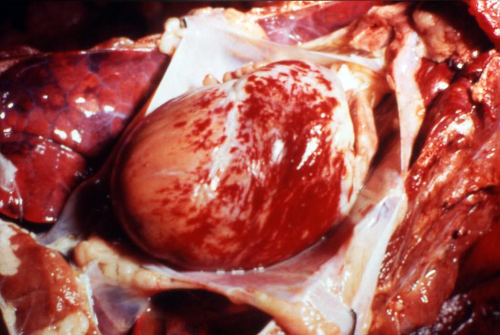 Appearance of heart Note the ecchymotic to suffusive