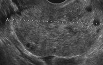 Ovarian torsion Ultrasound is modality of choice Features Unilateral enlarged ovary most common feature Uniform peripheral