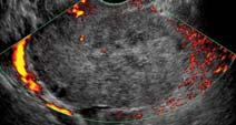 diagnosis Flow in the ovary does not exclude torsion Suggests the ovary may still be viable.