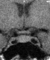 Polycystic ovarian syndrome MRI of pelvis Numerous small peripherally located cysts of the left ovary Normal appearing