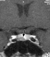 Suspect prolactinoma o p CA Post contrast image shows a microadenoma of the pituitary gland Tubo ovarian abscess