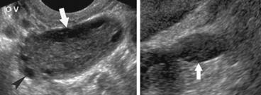 Note the relationship of the ovary with its supporting ligaments. Young vs.