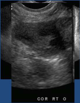 Asymptomatic 29 y/o Anechoic Thin walled Posterior acoustic enhancement Simple cyst Simple cyst In post menopausal women Common Seen in 10% of post menopausal women Malignancy incidence still low,