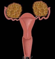 enlargement of both ovaries due to multiple theca lutein cysts of varying size.