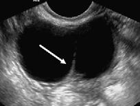 Note also the expanded uterine cavity (white open arrow) with fine enhancing septa (white curved arrow).